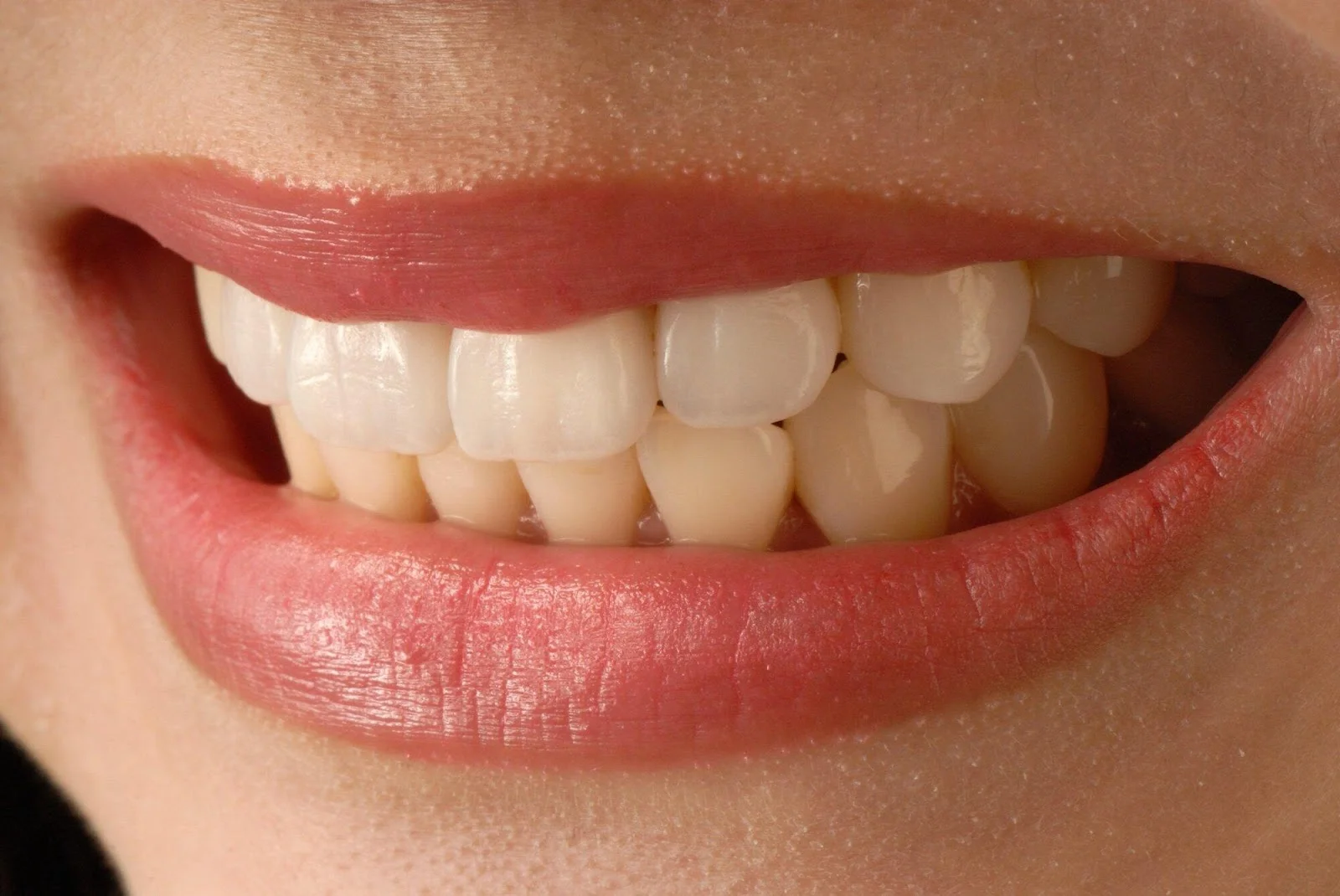 teeth prepped for veneers