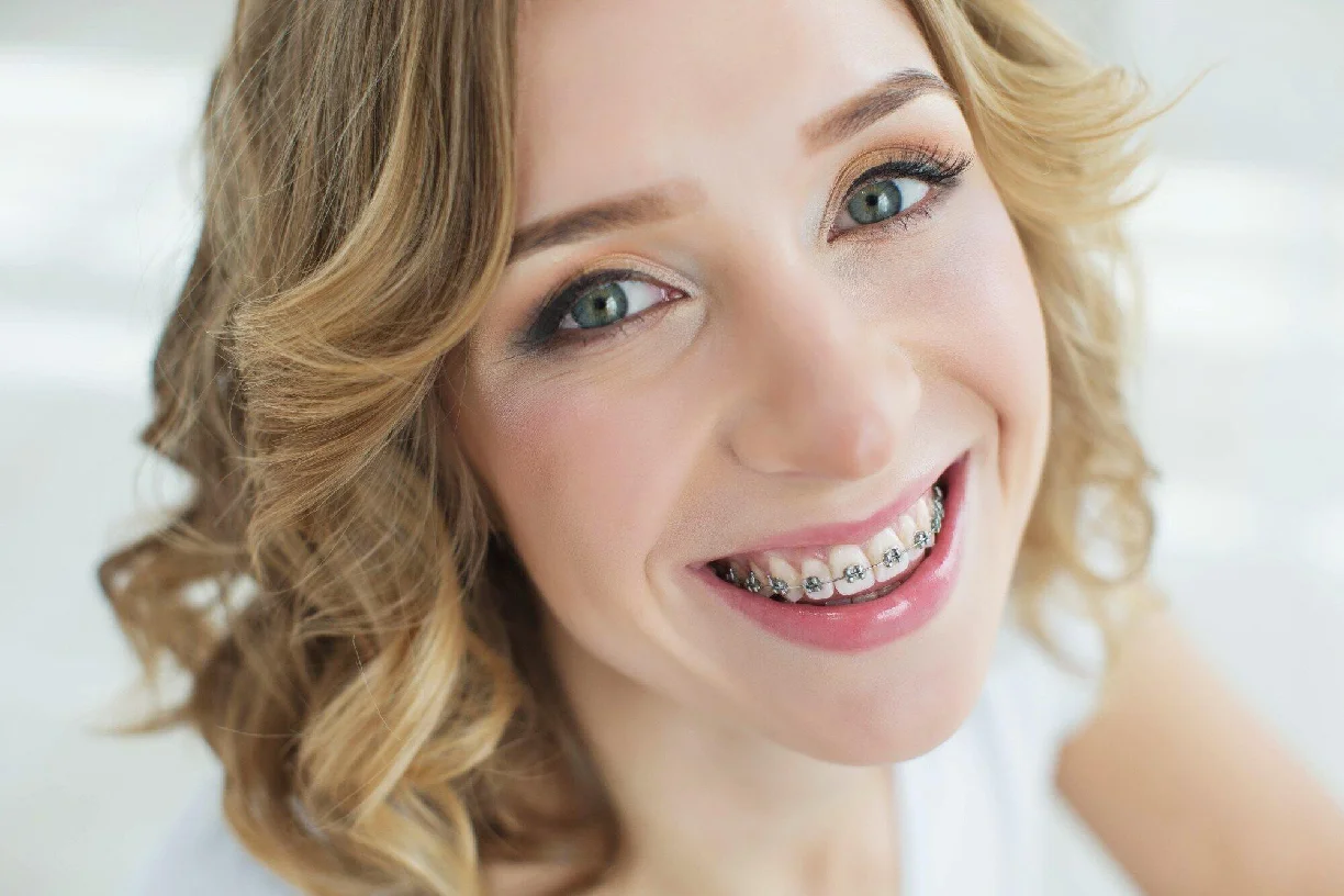 self-ligating braces