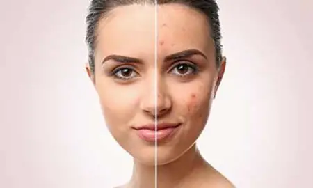Quadriderm Cream for Fungal Infections