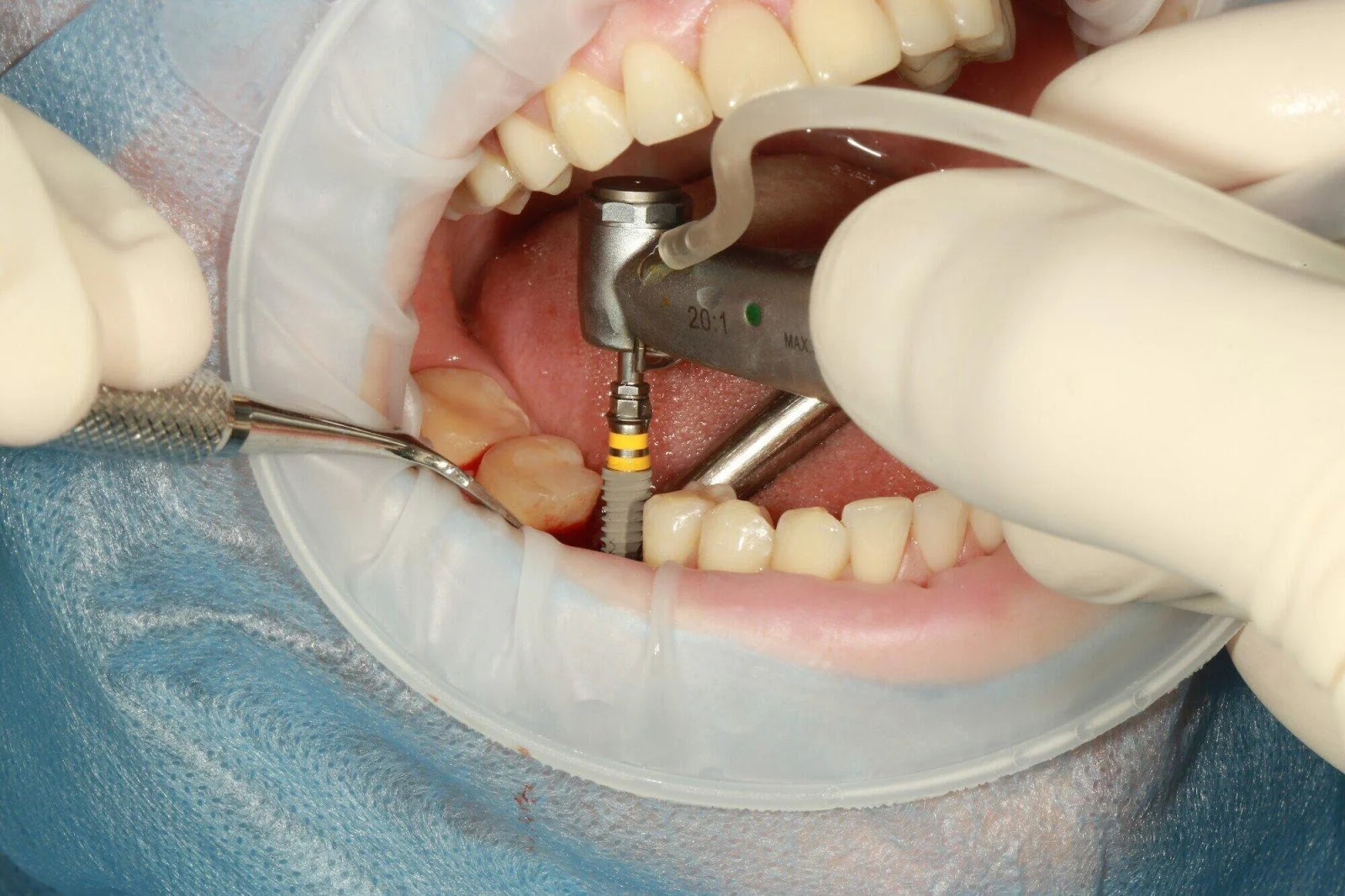 different types of tooth implants