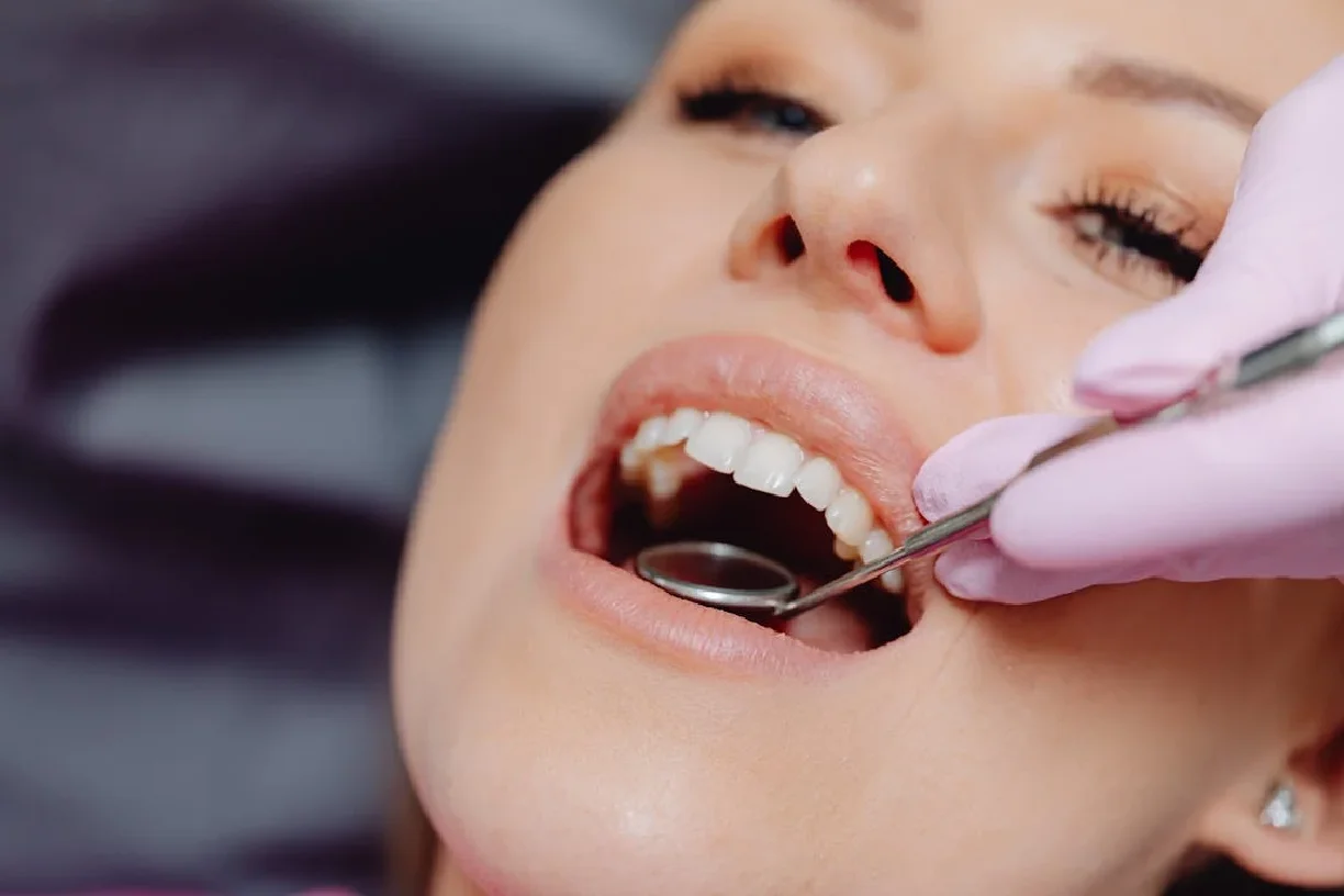 cavities between teeth
