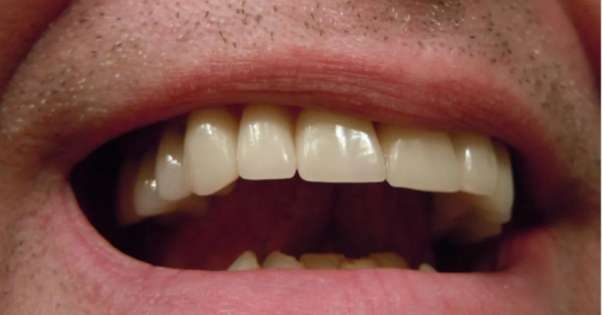 dental implant crowns