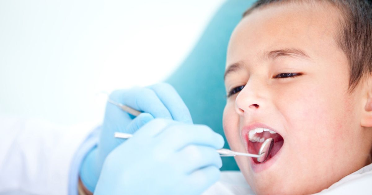 dental sealants vs fillings