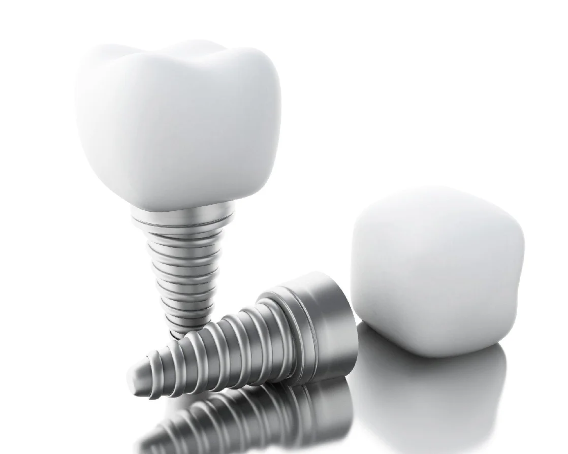 dental implant timeline