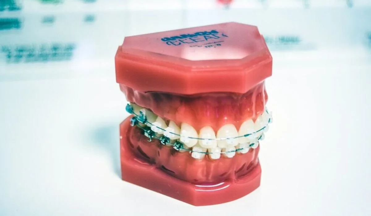 braces for underbite