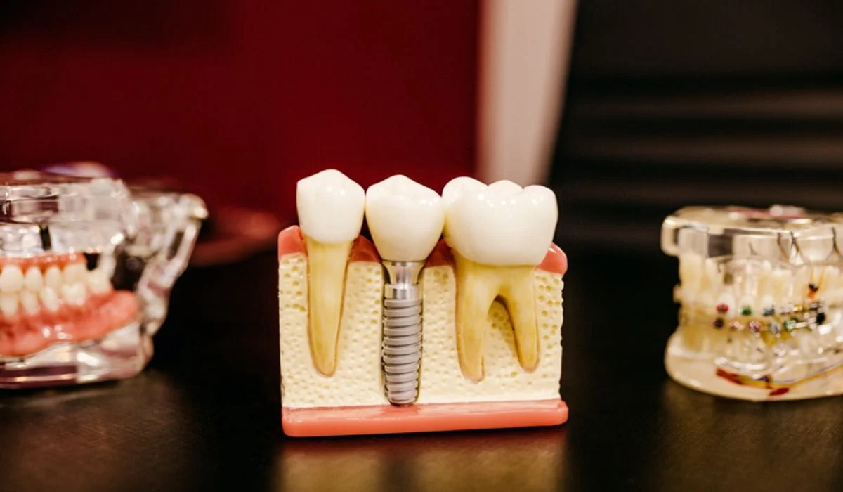 best teeth implants