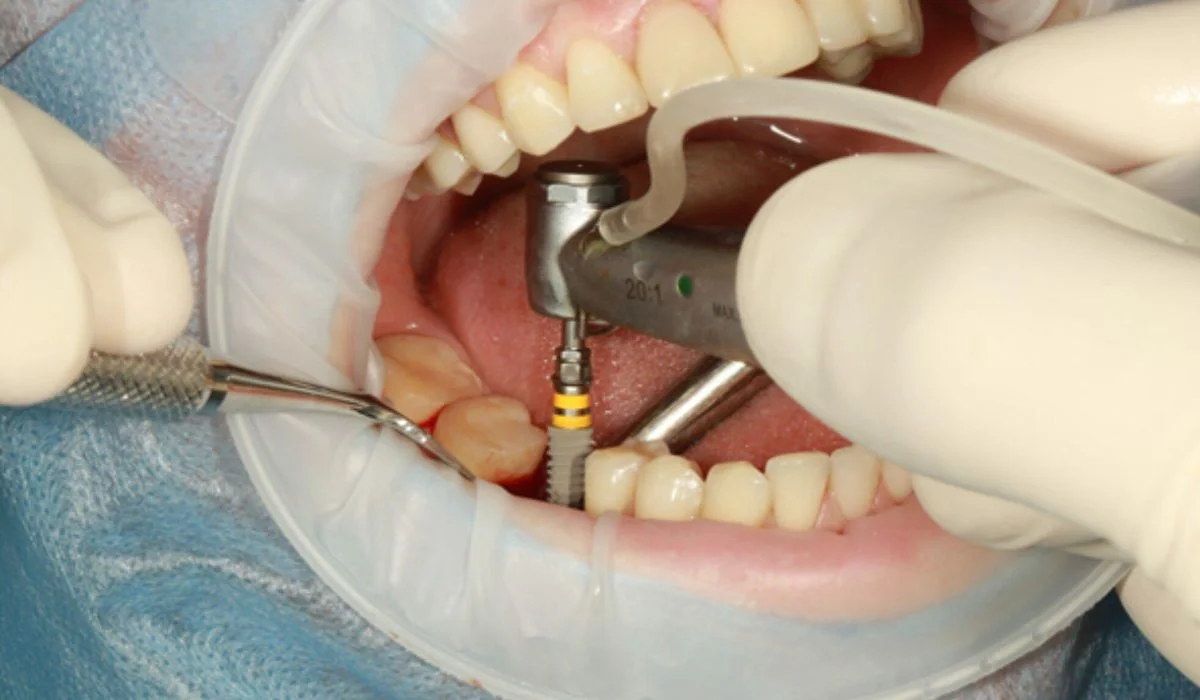most affordable dental implants