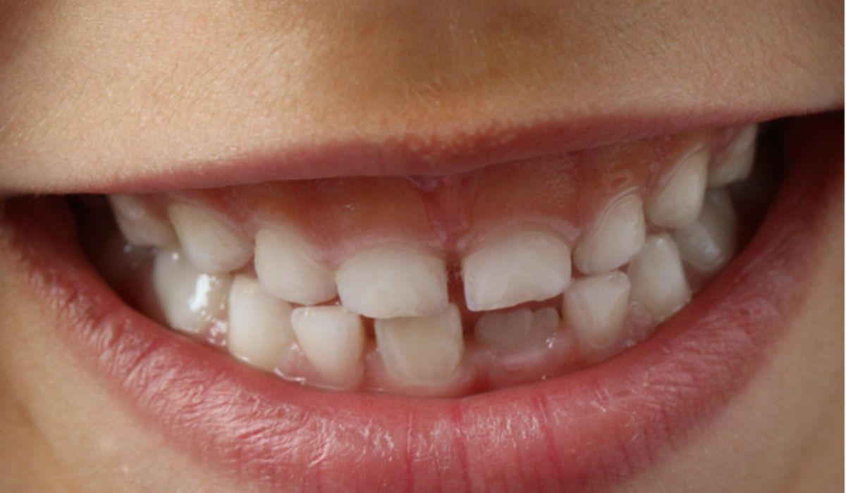 fixing gap in teeth