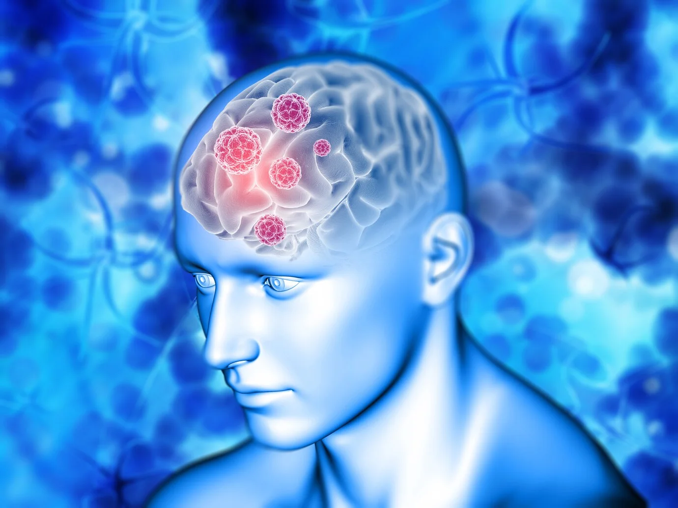 Aphasia