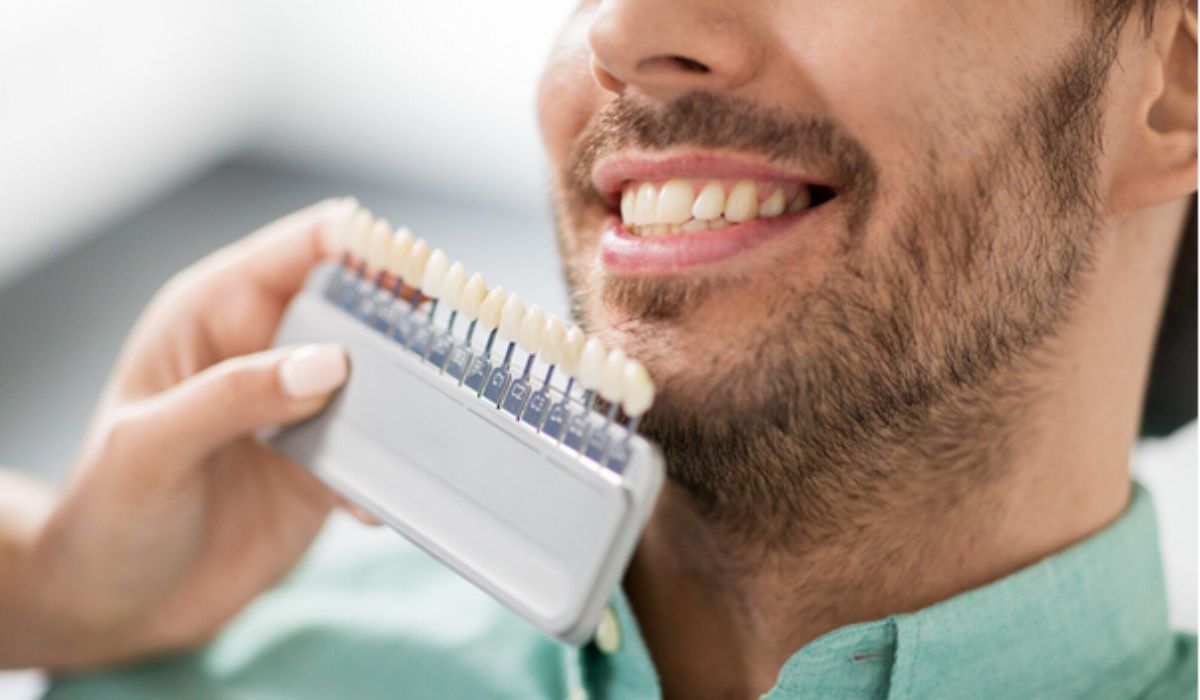 types of veneers