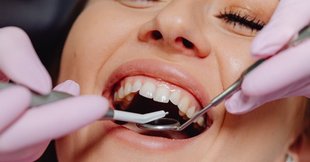 dental crowns