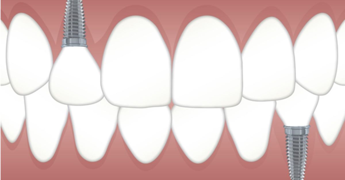 full-mouth dental implants
