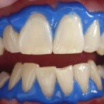 dental whitening