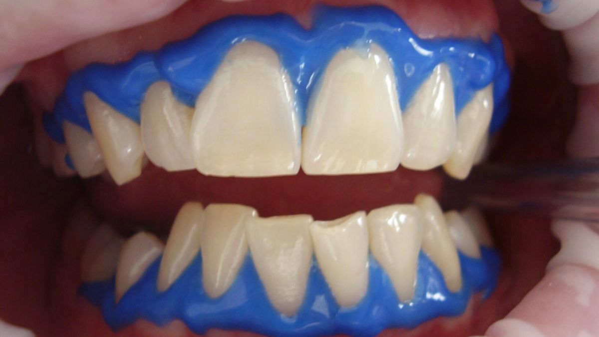 dental whitening