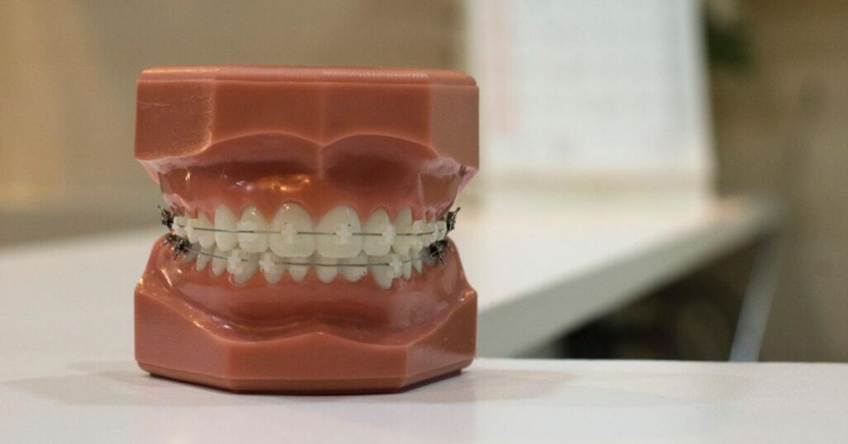 Looking into dental braces? Our ultimate guide explains types of braces, the treatment process, benefits, and costs to help you get a straighter smile.