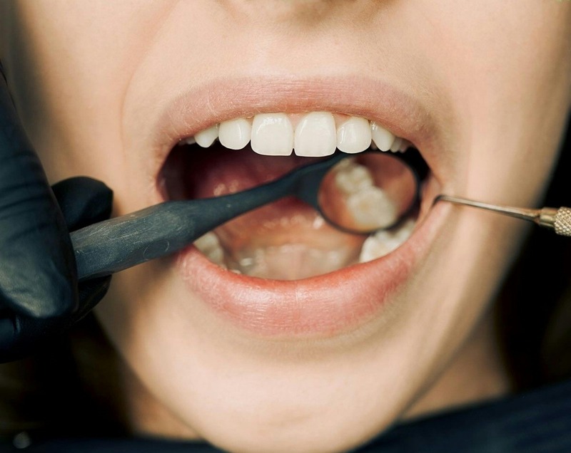 Dental Composites