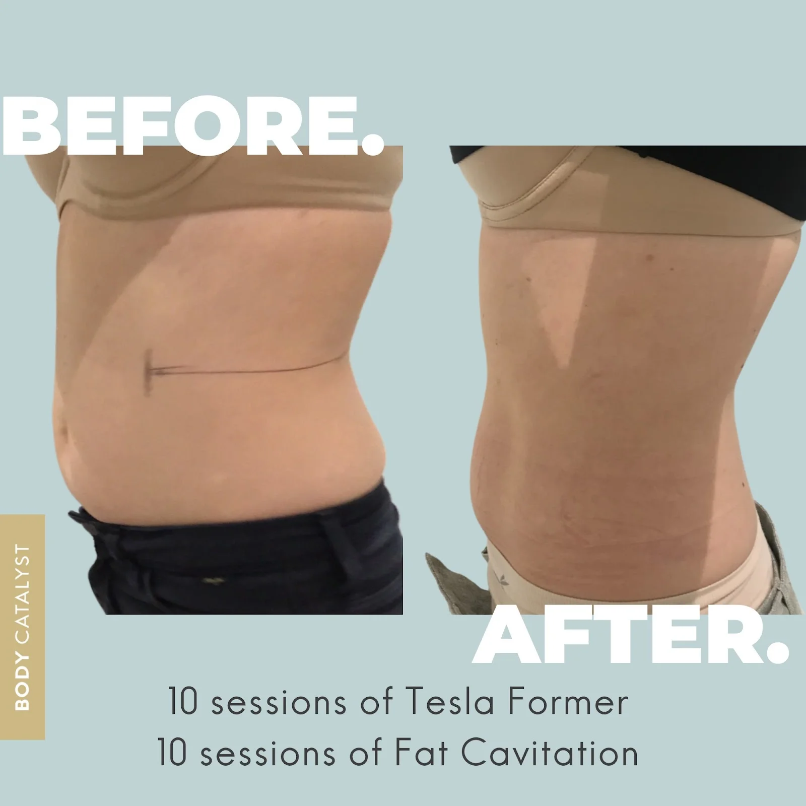 fat freezing