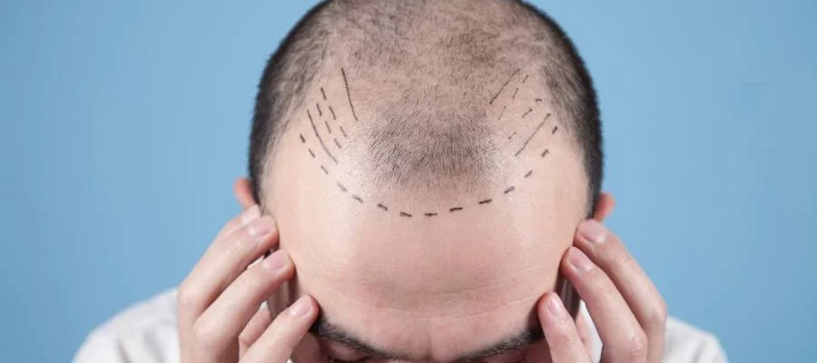 DHI Hair Transplant