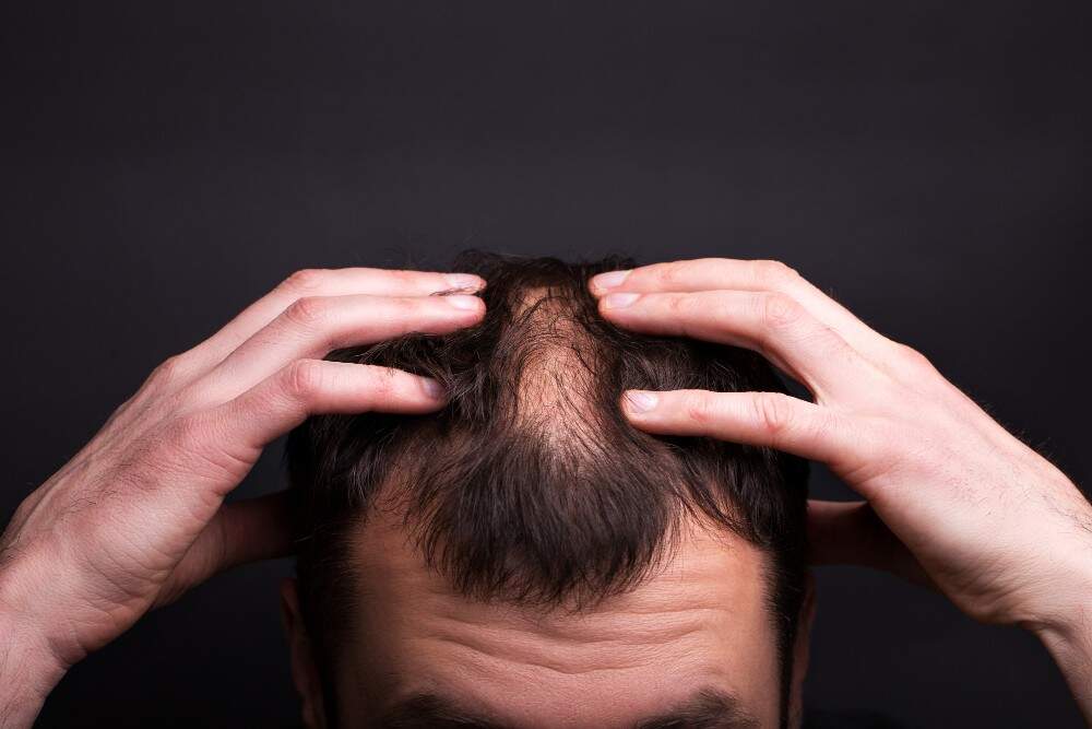 Hair Transplant