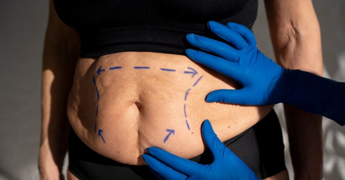 LIPOSUCTION OPTIONS